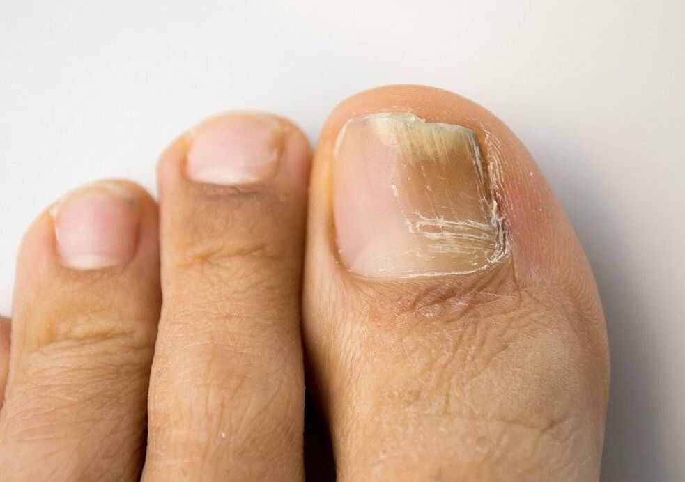 types of fungal infections in the thumb