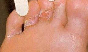 Dermaid lesions for mycosis of the foot