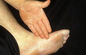 The erased form of mycoza manifests by peeling