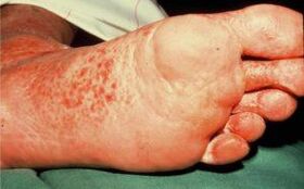 The fungus in the legs with ulcers