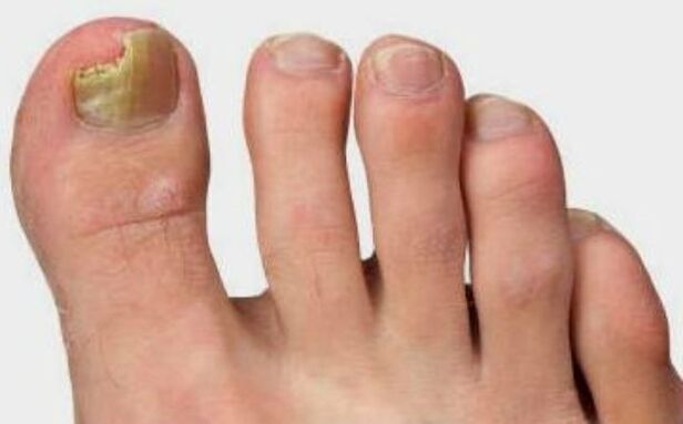 Mushrooms on the big toe