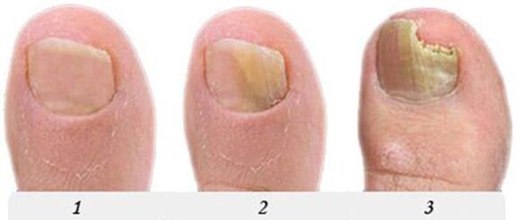 The process of developing fungi on the thumb