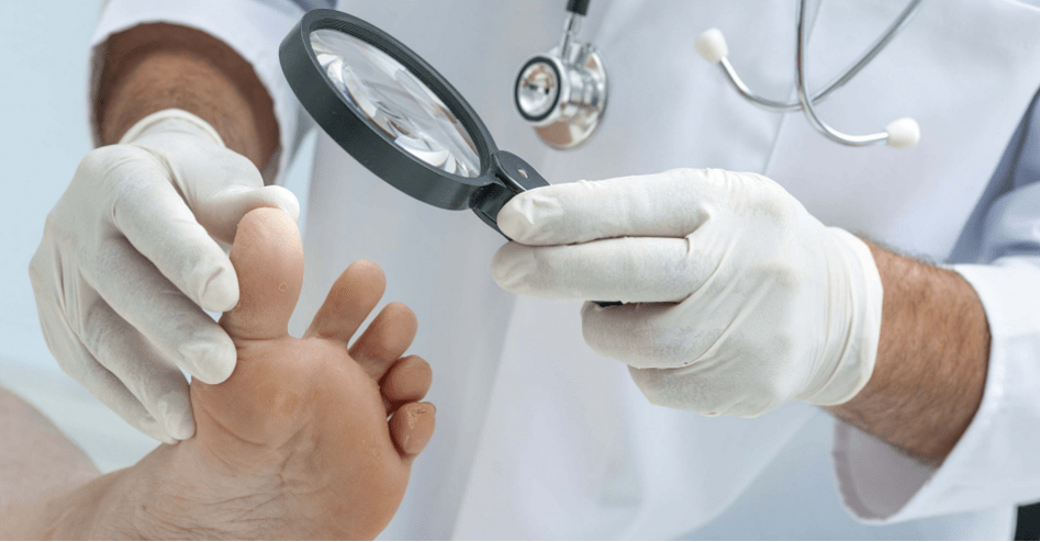 The first symptoms of the fungus in the legs