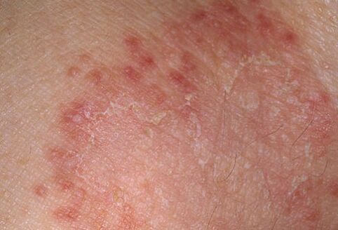 How to cure fungi quickly, the doctor will tell