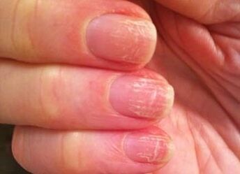 Initial phase of fungi on nails