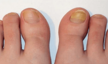 Initial stage of nail fungus