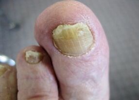 Causes of fungi appearance on nails
