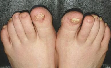 Mushroom signs on nails