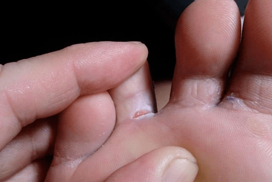 The appearance of bubble formations standing