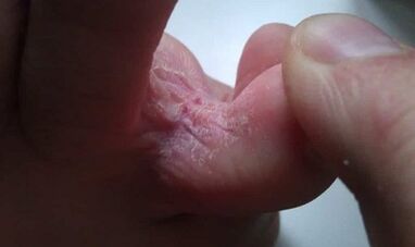 Stages of fungal development between fingers