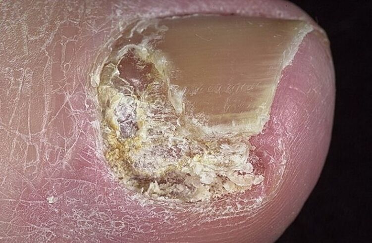 Types of onycomycosis