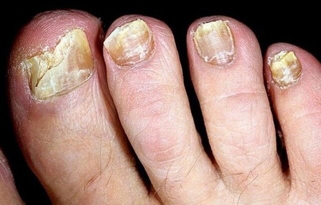 toenail fungus