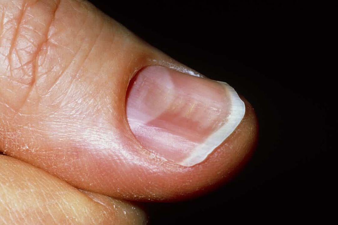 koilonychia in the nails