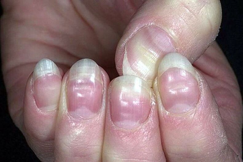 leukonychia in the nails