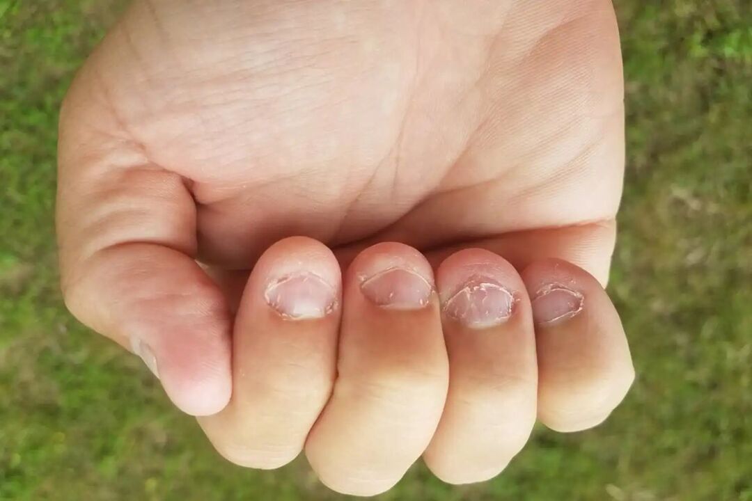 micronicia in the nails