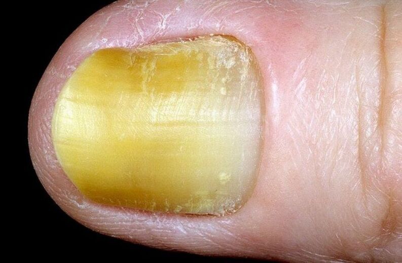 nail onycholysis