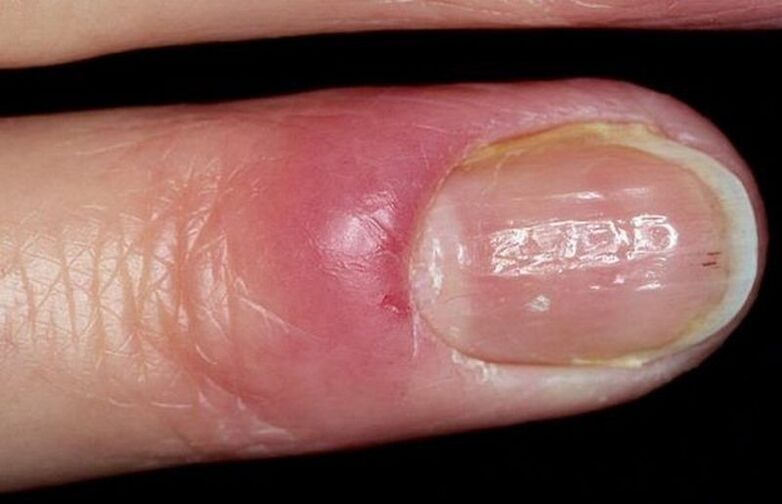 onisorexia of the nails